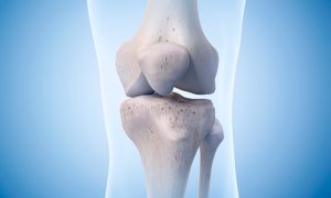 Knee Replacement