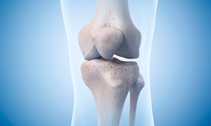 Knee Replacement