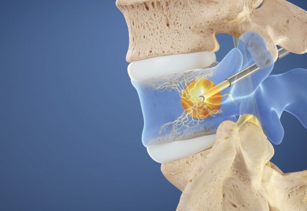 Gráfico del procedimiento intraceptivo