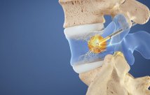 Gráfico del procedimiento intraceptivo