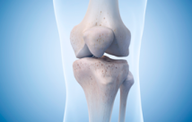 Knee Replacement